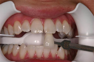 po bělení zubů