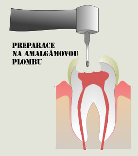 Amalgámová plomba