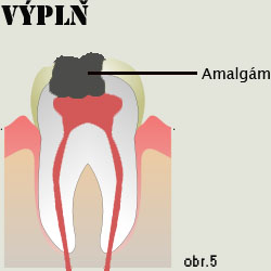 Amalgám