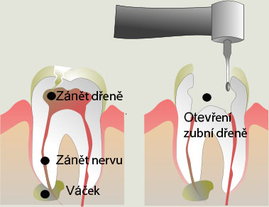 Zánět dřeně