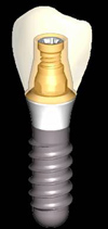 Zubní implantát Zubní implantát