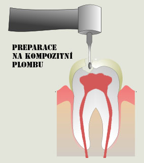 Kompozitní plomba