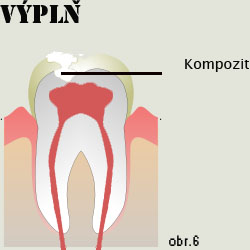 Kompozitní plomba