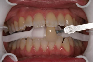 před bělením zubů