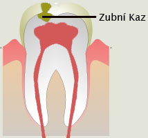 Zubní kaz